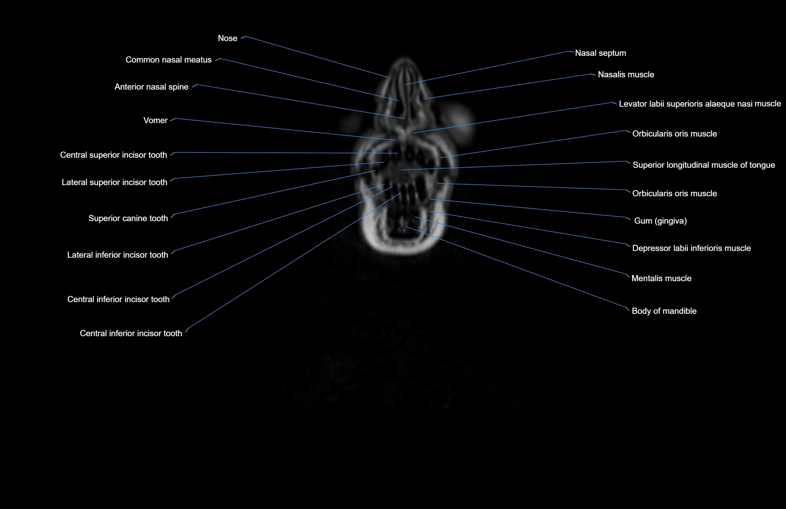 Neck coronal cross sectional MRI anatomy 3T MRI  image-img-00001-00076.webp